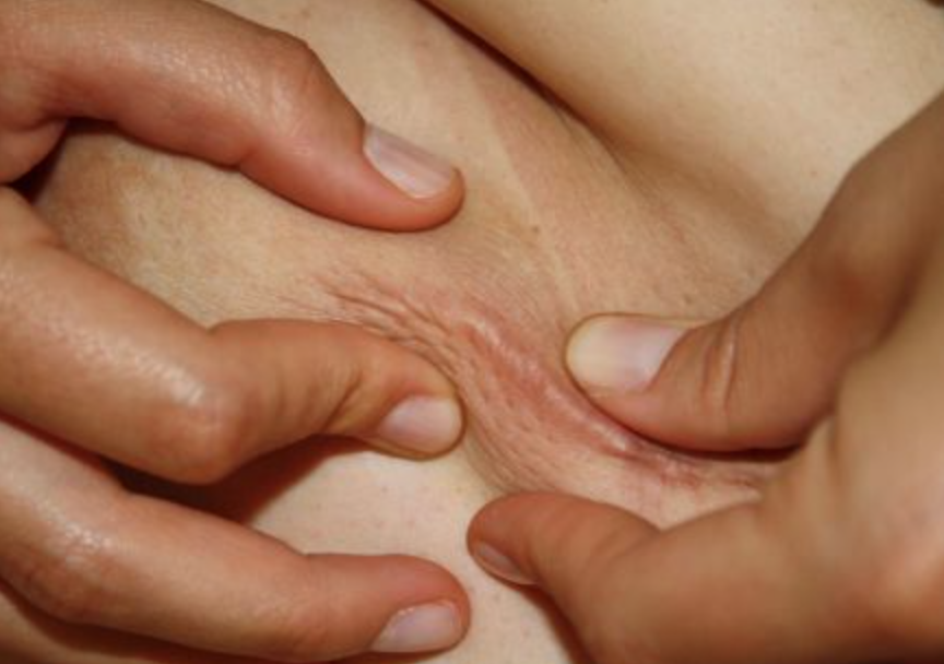 Scar Management - Fysio Jansen