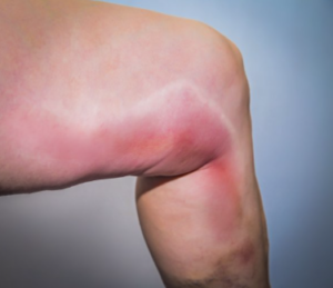 Thromboflebitis aderontsteking Fysio Jansen Deurne