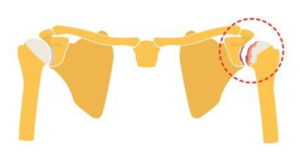 Artrose schouder l Symptomen en fysiotherapie l Deurne