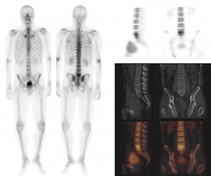 Skeletscintigrafie oftewel botscan | Wij geven uitleg