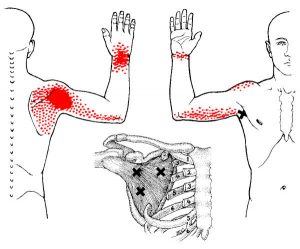 Referred Pain Fysio Jansen Deurne